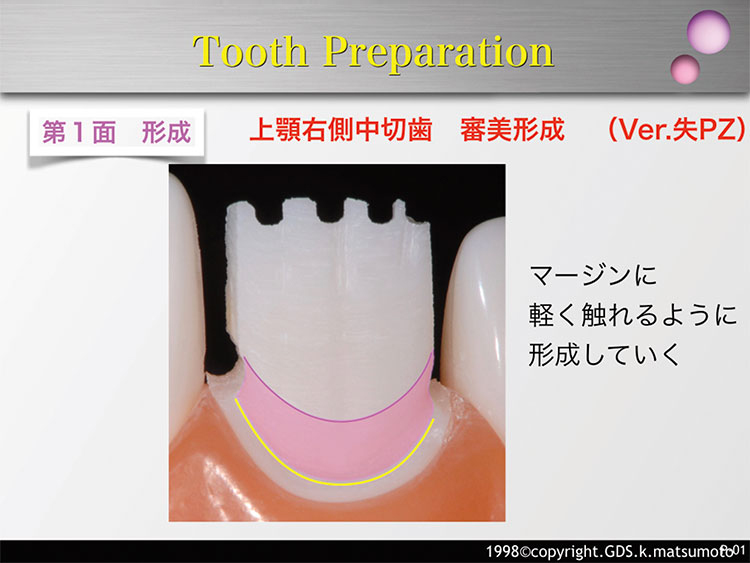 図13　歯頸部1/3の形成（使用バー：MP-3）
