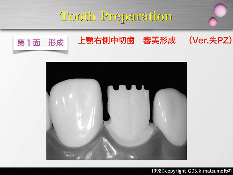 図14　歯頸部1/3の形成（使用バー：MP-3）