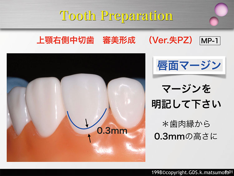 図4　唇側面マージンの形成（使用バー：MP-1）