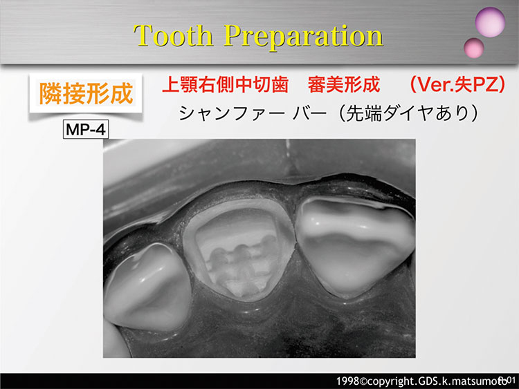 図22　隣接面第1面・第2面の形成（使用バー：MP-4）