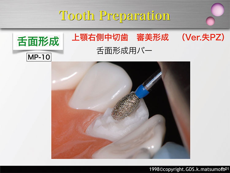 図23　舌面の形成（使用バー：MP-10、下顎はMP-11）