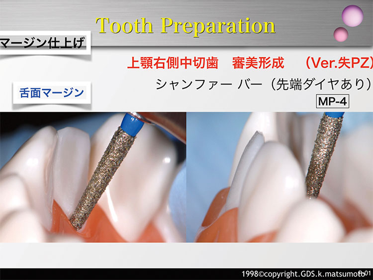 図27　側軸面の形成（使用バー：MP-4）