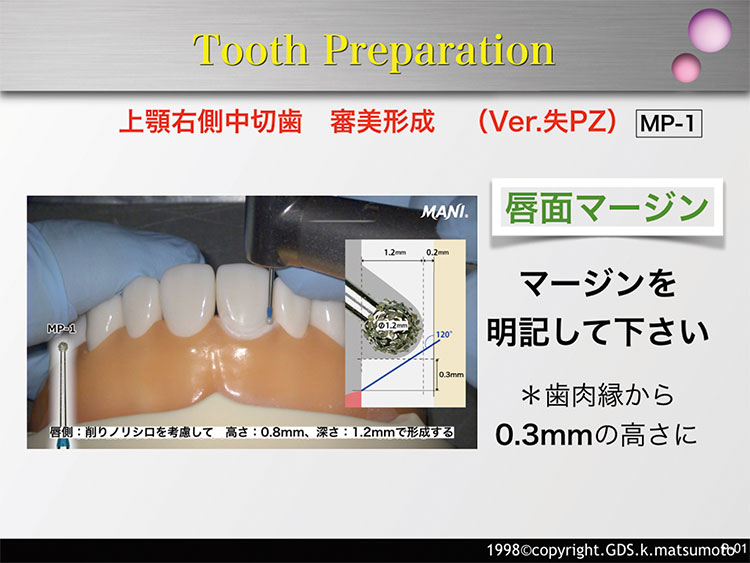 図5　唇側面マージンの形成（使用バー：MP-1）