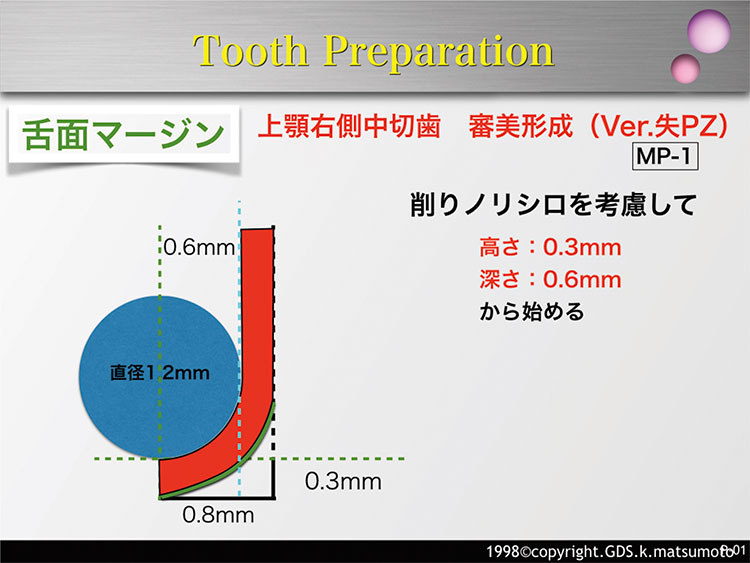 図6　舌側面マージンの形成（使用バー：MP-1）