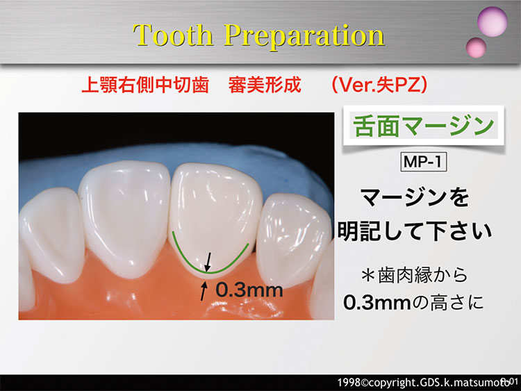 図7　舌側面マージンの形成（使用バー：MP-1）