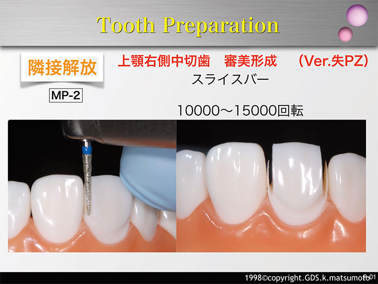 図8　隣接面の開放（使用バー：MP-2）