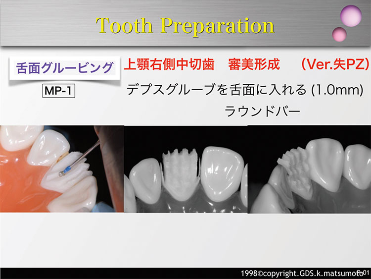 図11　舌面のグルービング（使用バー：MP-1）