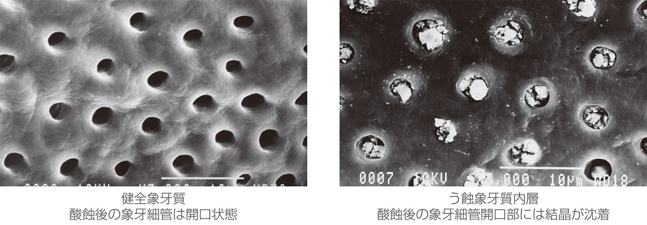 図2　健全象牙質とう蝕象牙質内層の象牙細管開口部の観察