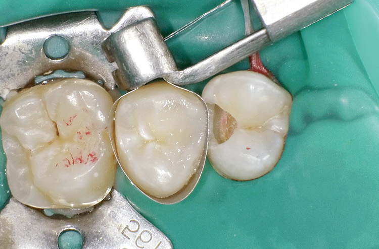 図17　積層充填の第3層目としてペーストタイプレジンを充填して形態付与。