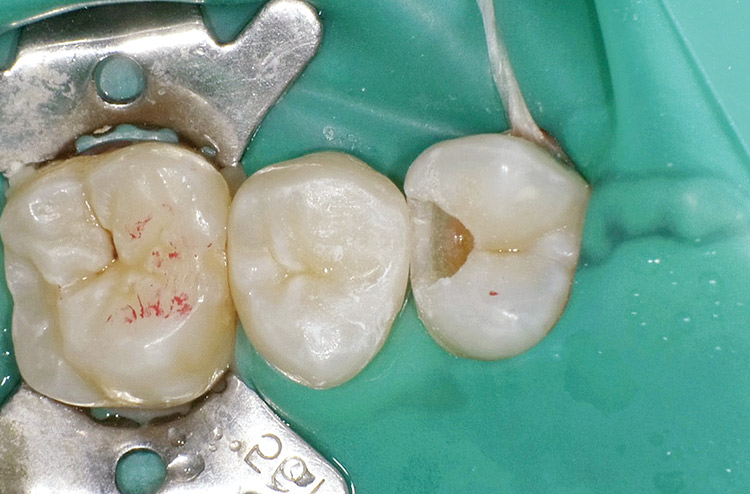 図18 充填操作を完了して隣接面部分の研磨操作を行った。