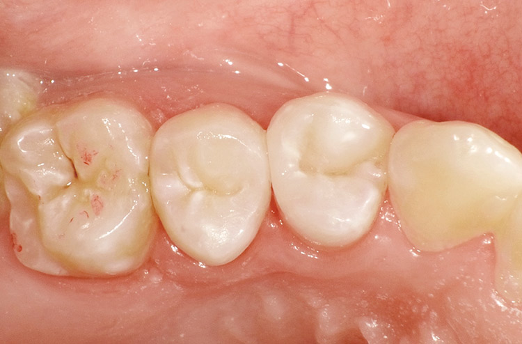 図26　術後。緊密な隣接面接触関係が再構築された。