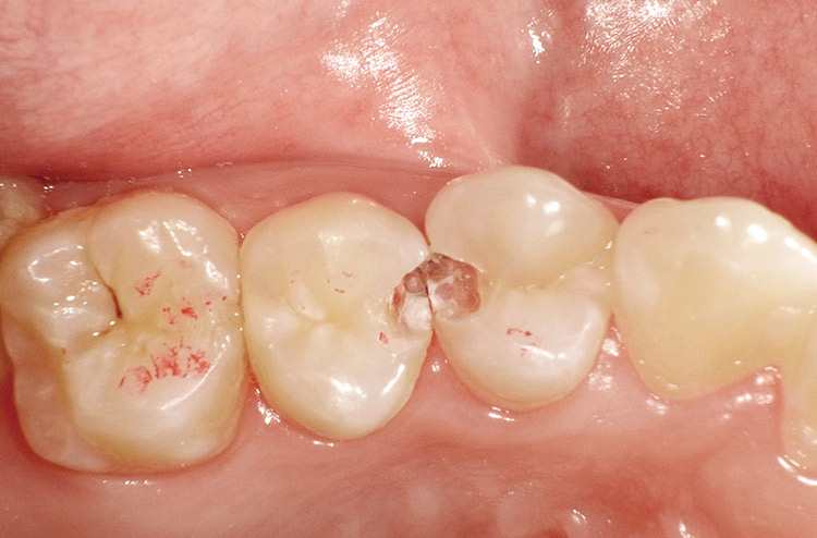 図8 のう窩を開拡し、う蝕の全体像を把握。
