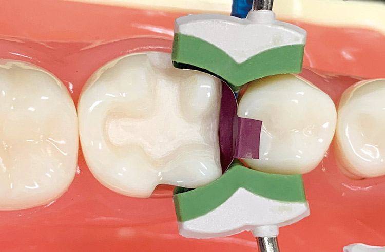 図16　3Dリテーナー フュージョン装着バンドが隣接歯に密着し、また歯肉側マージンがしっかりと封鎖されていることを確認。