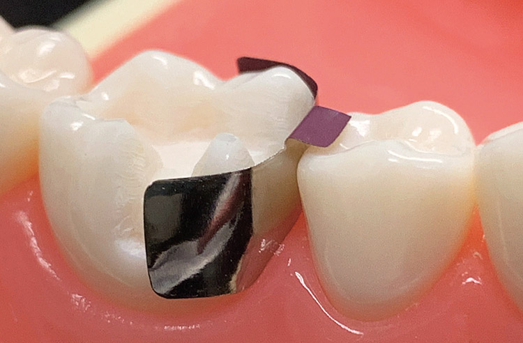 図4　歯肉溝にわずかに入り辺縁隆線部に一致するセミスタンダードを選択。