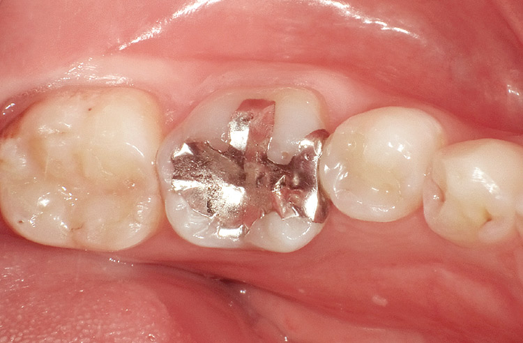 図17　術前　MOメタルインレーの二次う蝕による再修復。