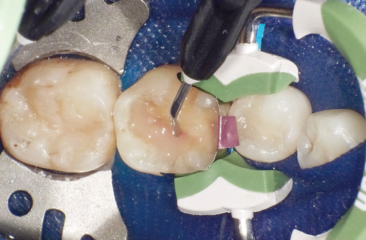 図26　コンポジットレジン充填−1 クリアフィルマジェスティ ESフロー Lowを窩底部に一層充填し光照射。
