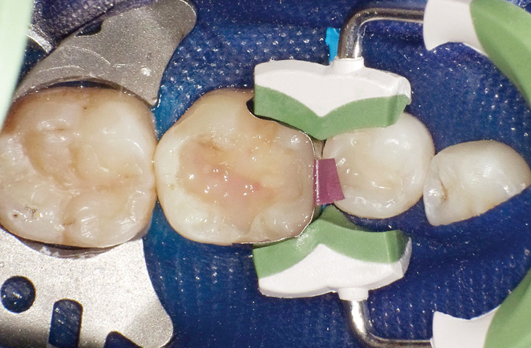 図27　コンポジットレジン充填−2 ESフロー Super Low による隣接面辺縁隆線部の充填。