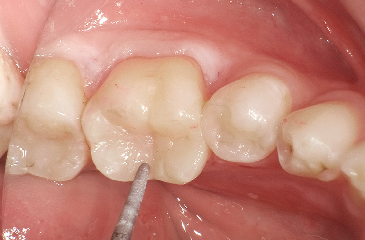 図31　咬合調整超微粒子ダイヤモンドポイントによる咬合調整。