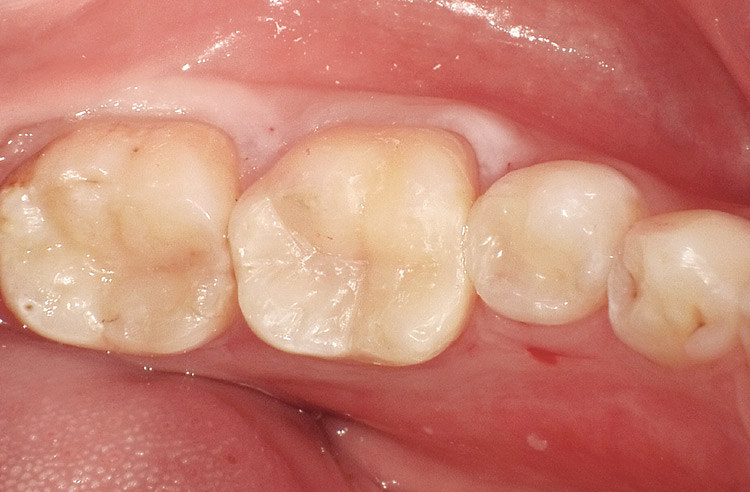 図34　術直後隣接面の欠損が大きい症例においても、3Dリテーナー フュージョンLを用いることで、緊密な接触点を持つ適切な隣接面形態のコンポジットレジン修復が可能。