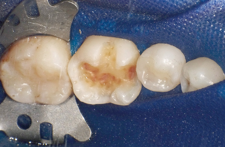 図18　ラバーダム防湿とメタルインレー除去ラバーダム防湿後、メタルインレーを除去。咬合面窩底部に感染象牙質が認められる。