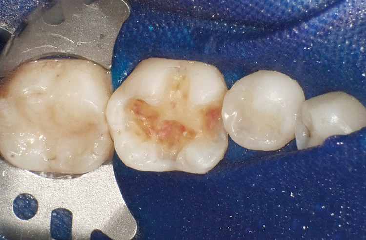 図20　感染象牙質の除去 染色部分をスプーンエキスカベーターで除去。