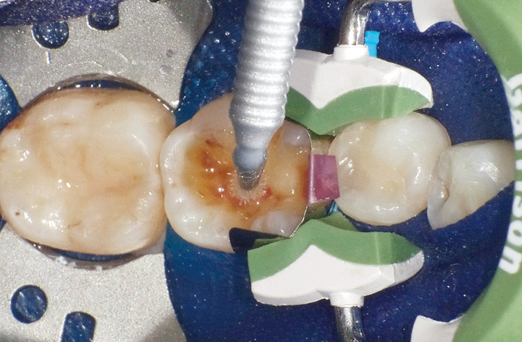 図22　クリアフィルメガボンド2による接着処理−1（プライマー処理）プライマーを窩洞内にたっぷりと塗布。