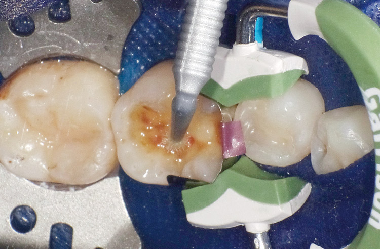 図24　接着処理−2（ボンド処理）窩洞内にボンドを塗布。