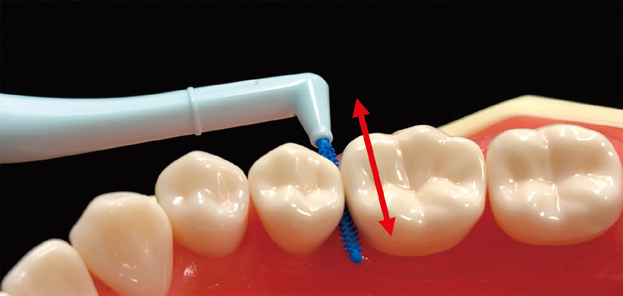 図2　歯間ブラシを用いた清掃の様子