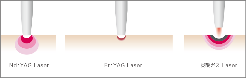 Nd:YAGレーザー、Er:YAGレーザー、炭酸ガスレーザーの組織透過性等の特性