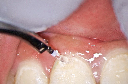 罹患歯質の除去時の写真