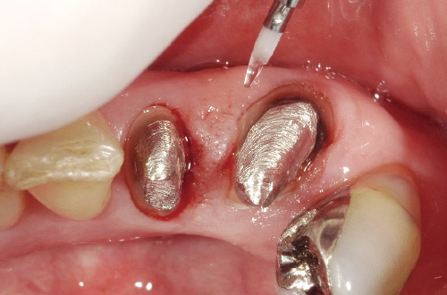 不適冠除去後の辺縁歯肉切除の写真