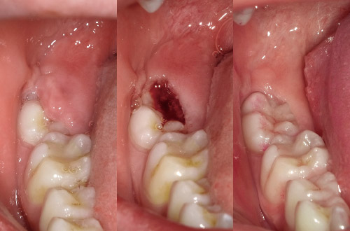 萌出時の歯冠周囲炎の写真