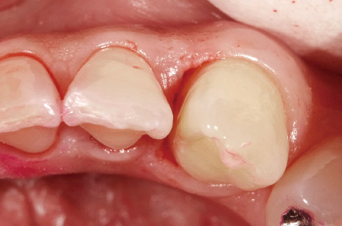 歯肉縁下のデブライドメント後の写真