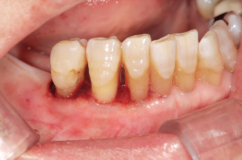 垂直性骨欠損を伴う広汎型慢性歯周炎の写真