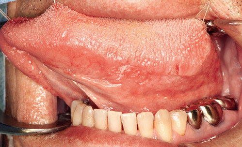 舌左側縁の粘膜不整の写真