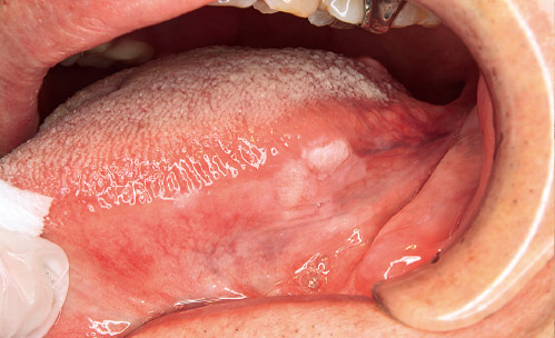舌左側縁に白板状の変化と粘膜不整をともなった病変の写真