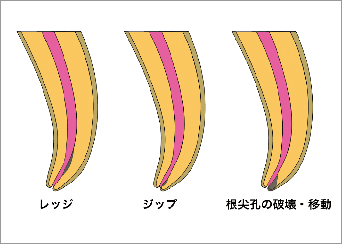 湾曲根管にて起こりうる偶発事故の図