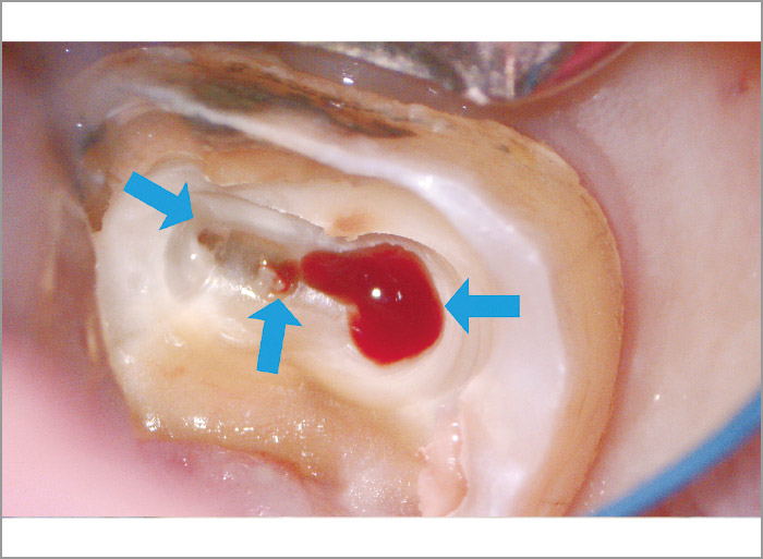 う蝕を除去し根管口を明示した写真