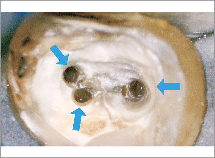 根管拡大を終了した写真