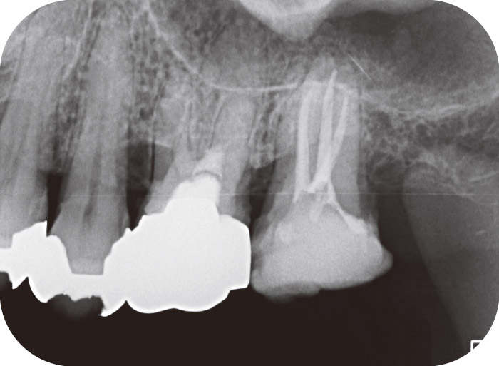 根管充填終了時のX線画像