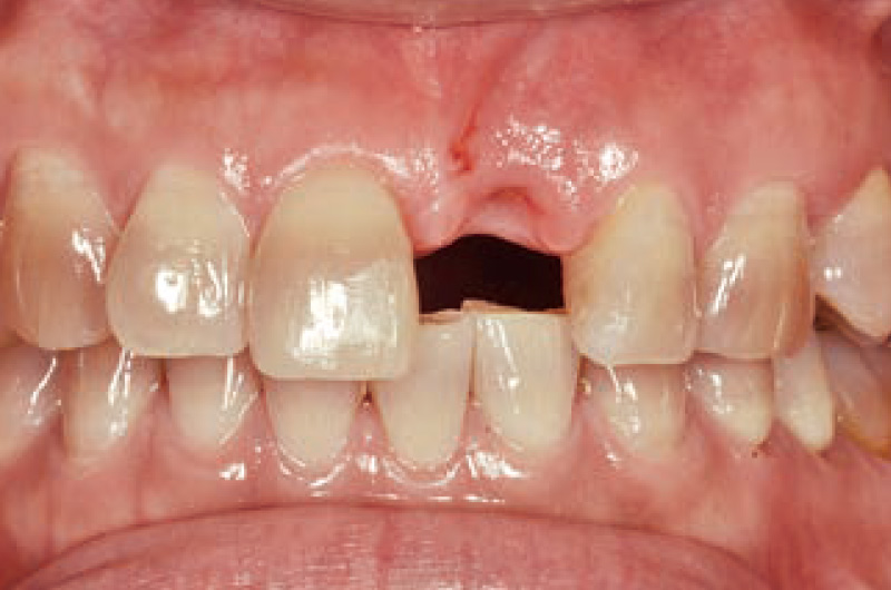[写真] 左側中切歯欠損の口腔内写真