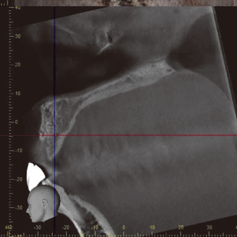 [写真] X線診断用ガイドを装着した状態でのCBCT所見