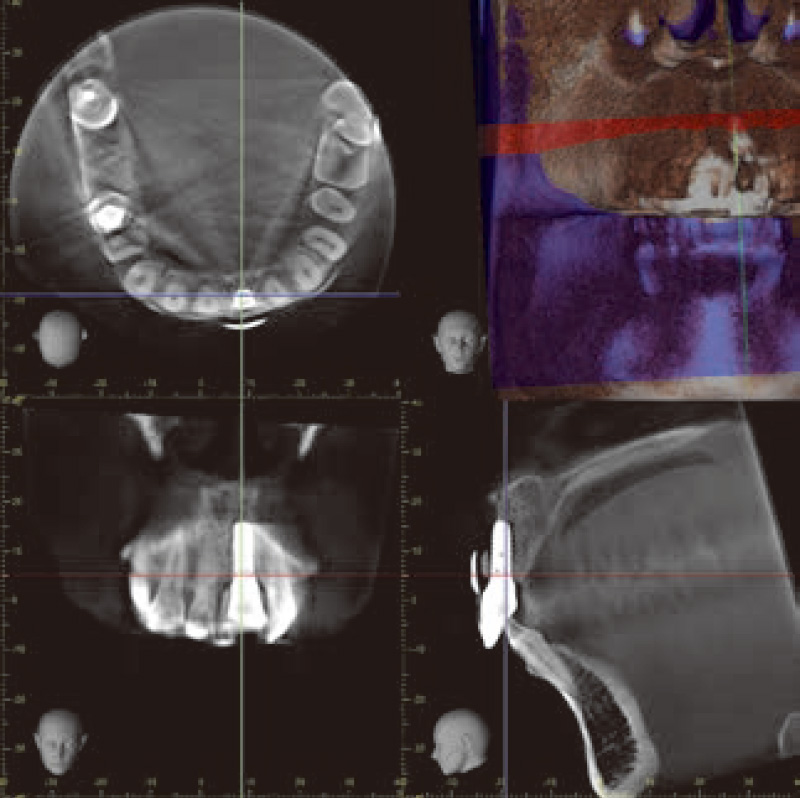 [写真] レジン付与した状態で撮影したCBCT画像