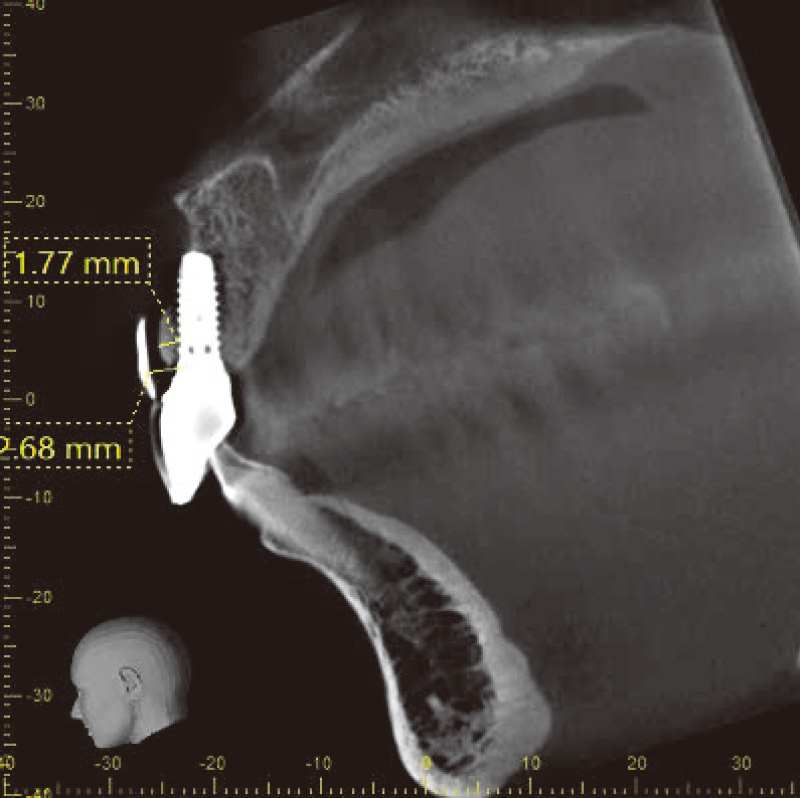 [写真] 唇－ 口蓋方向のCBCT断面