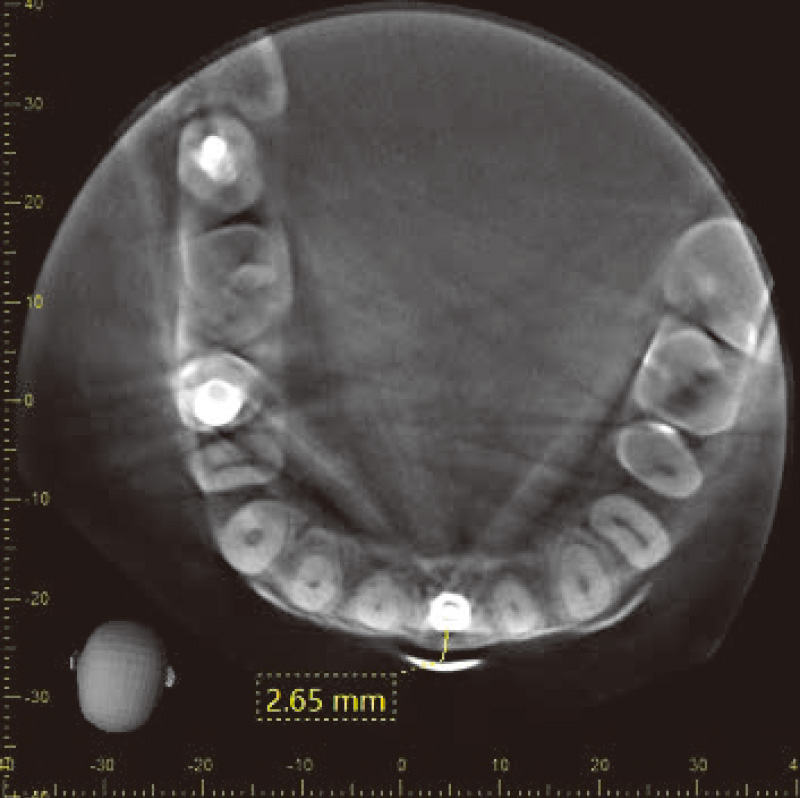 [写真] 水平断のCBCT所見