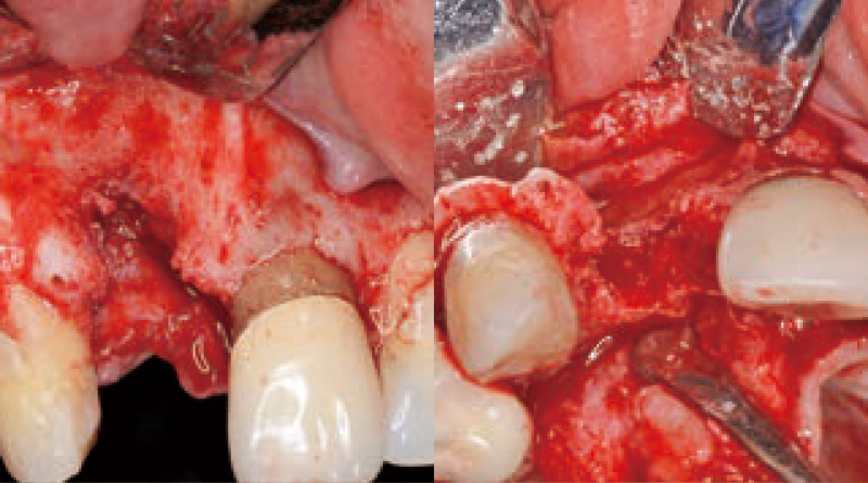 [写真] 水平性かつ垂直性の骨吸収を認める
