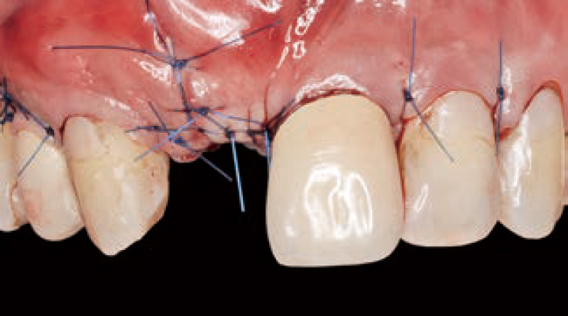 [写真] 水平マットレスを根尖側、より歯冠側の2ヵ所で縫合し、切開線は単純縫合で閉鎖