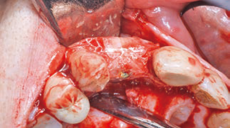 [写真] メンブレン直下に認める新生骨様組織が口蓋側にも確認された