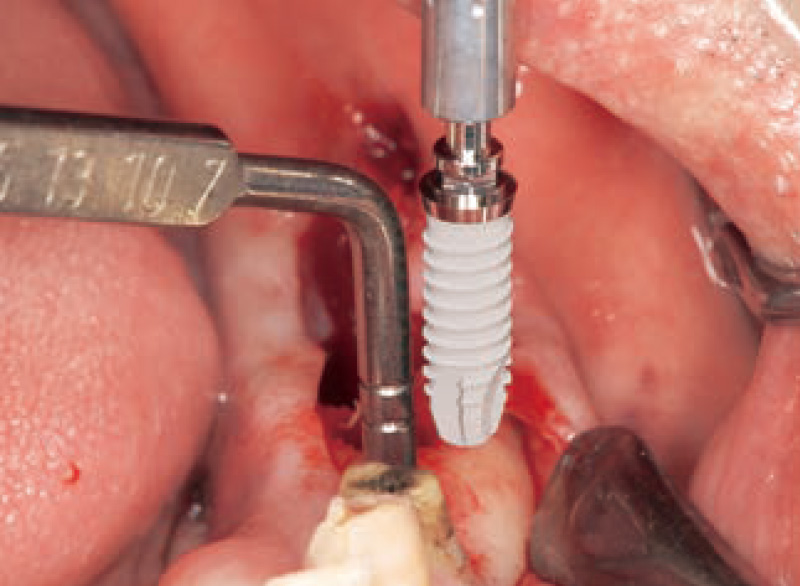 [写真] 通法通りインプラント埋入窩を形成し予定部位にフィクスチャ―を埋入していく