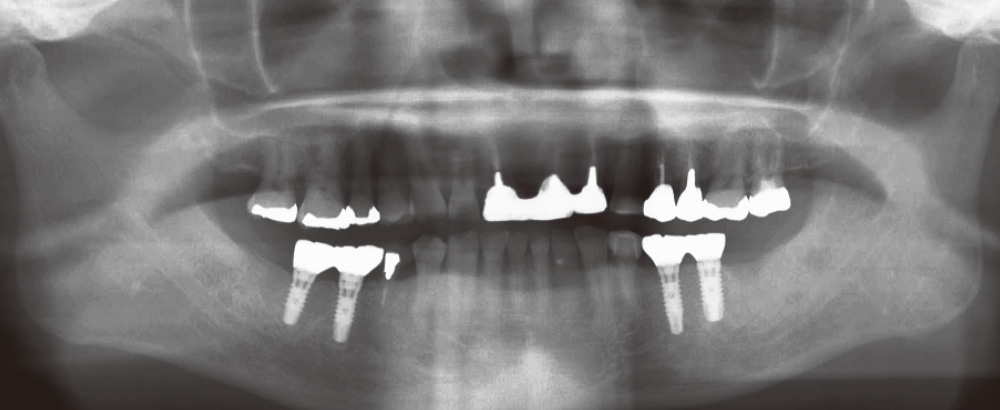 [写真] 治療終了から一年後のパノラマX線写真